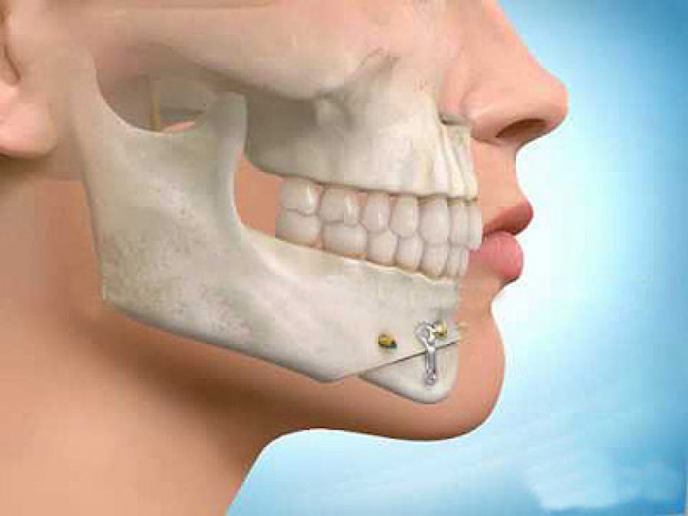 La zona maxilofacial es lo que recoge la boca, dientes, la cara, la cabeza y el cuello.
Cefalea sexual