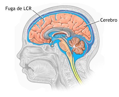 El líquido cefalorraquídeo es un líquido transparente e incoloro que se encuentra en el cerebro y la médula espinal. 
Cefalea sexual